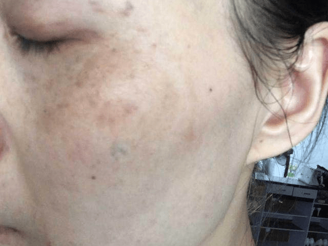 再多的痘痘斑点,这样做能让它们消失!_肠道