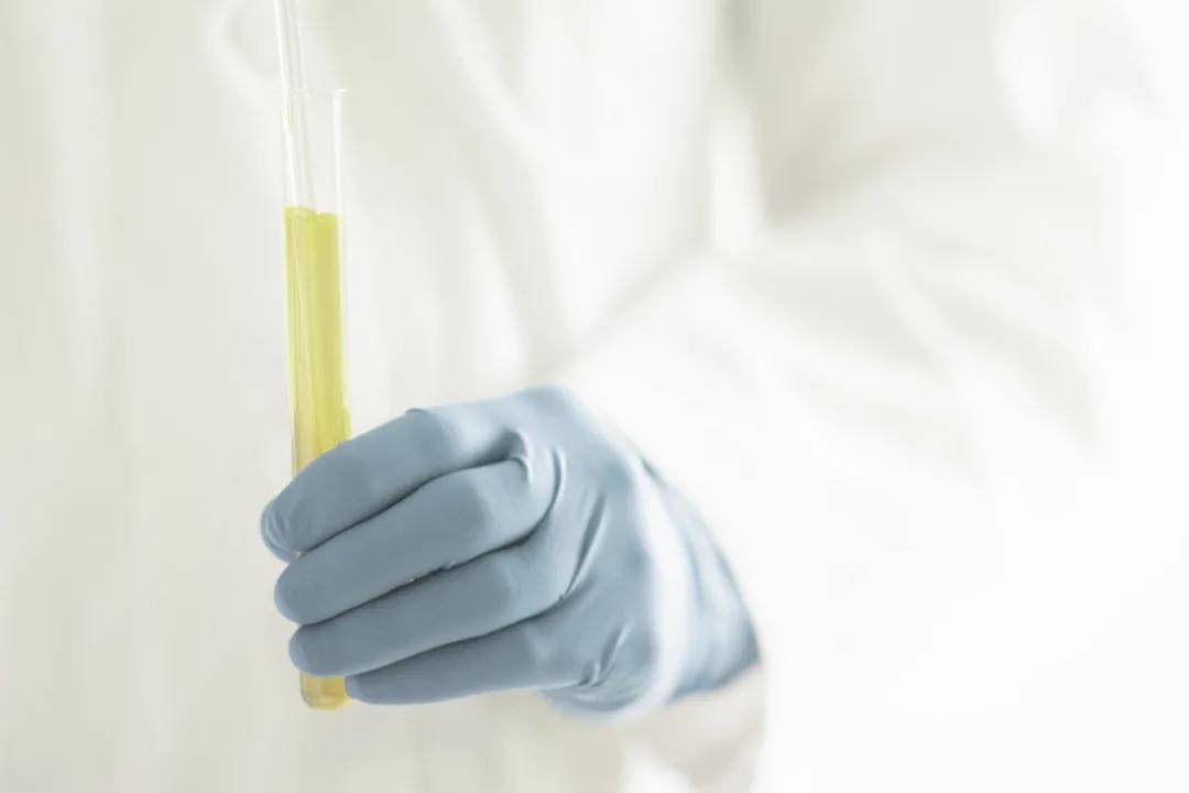 怎样才算尿里有泡沫 452f6ad8f9fe47c0aeaa435dbf8758b6.jpeg