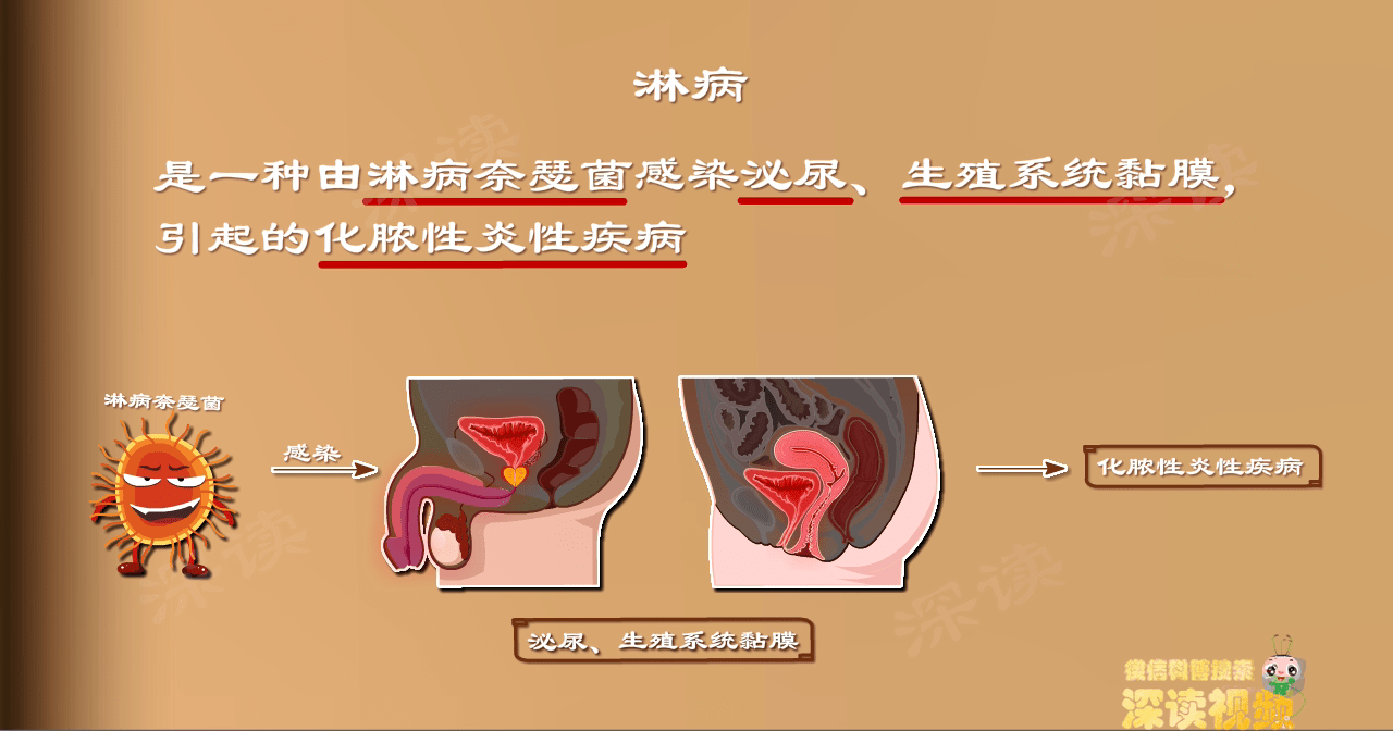 我國每年淋病新發病例13萬穩居性病熱搜榜top5淋病到底是個啥