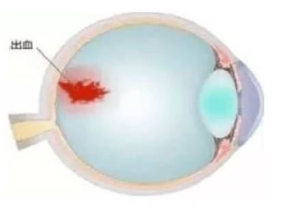 首大聂红平 巩膜出血该怎么治 进行