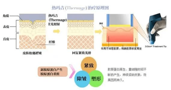 治疗|极塑波属于面部射频超声同步抗衰美容仪器吗？