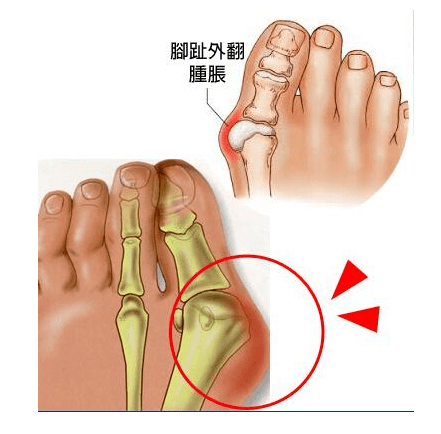 脚拇外翻怎么办