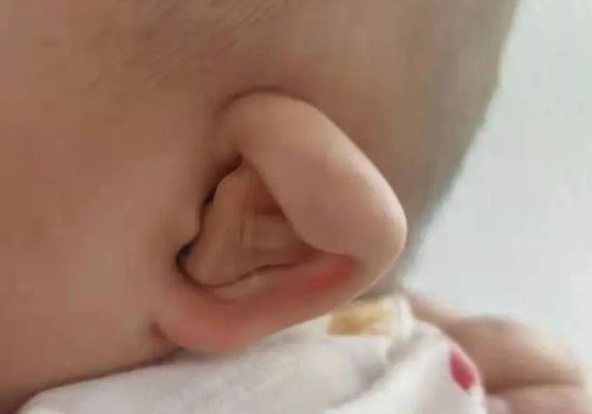 你以为的招风耳,其实是一种耳廓畸形(上)