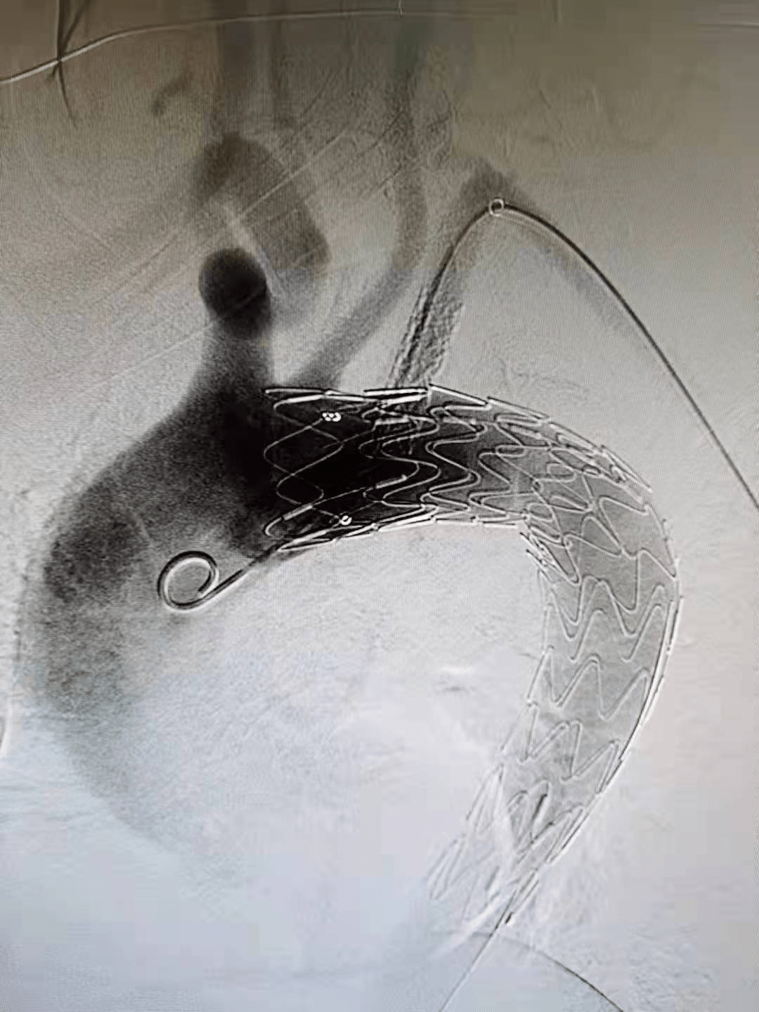 团队|罕见又危险！巨大溃疡长在主动脉上！人民医院专家团队通力合作让患者转危为安