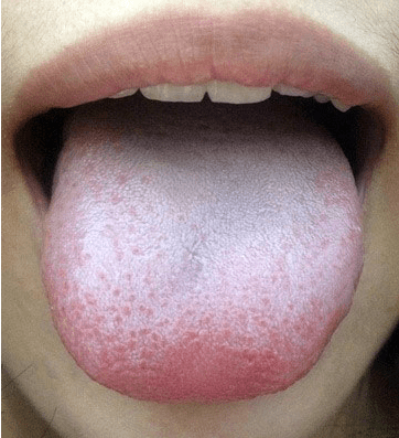 肺结核舌头图片图片