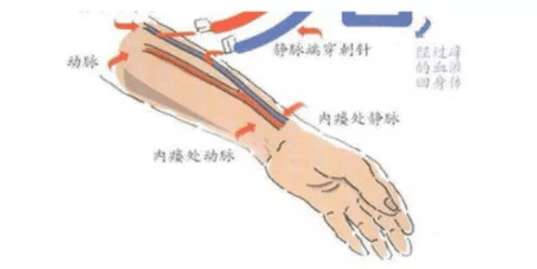 腹膜|慢性肾脏病患者的“持久战”——肾脏替代治疗