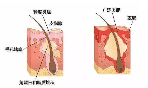 脸部毛孔粗大怎么办？别慌，敷ta，让你恢复细滑少女肌