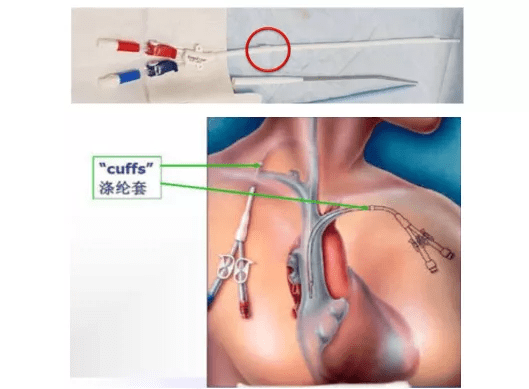 腹膜|慢性肾脏病患者的“持久战”——肾脏替代治疗