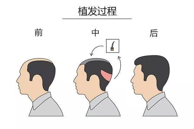 知识科普普拉朵植发丨植发真的不能让头发数量变多吗？