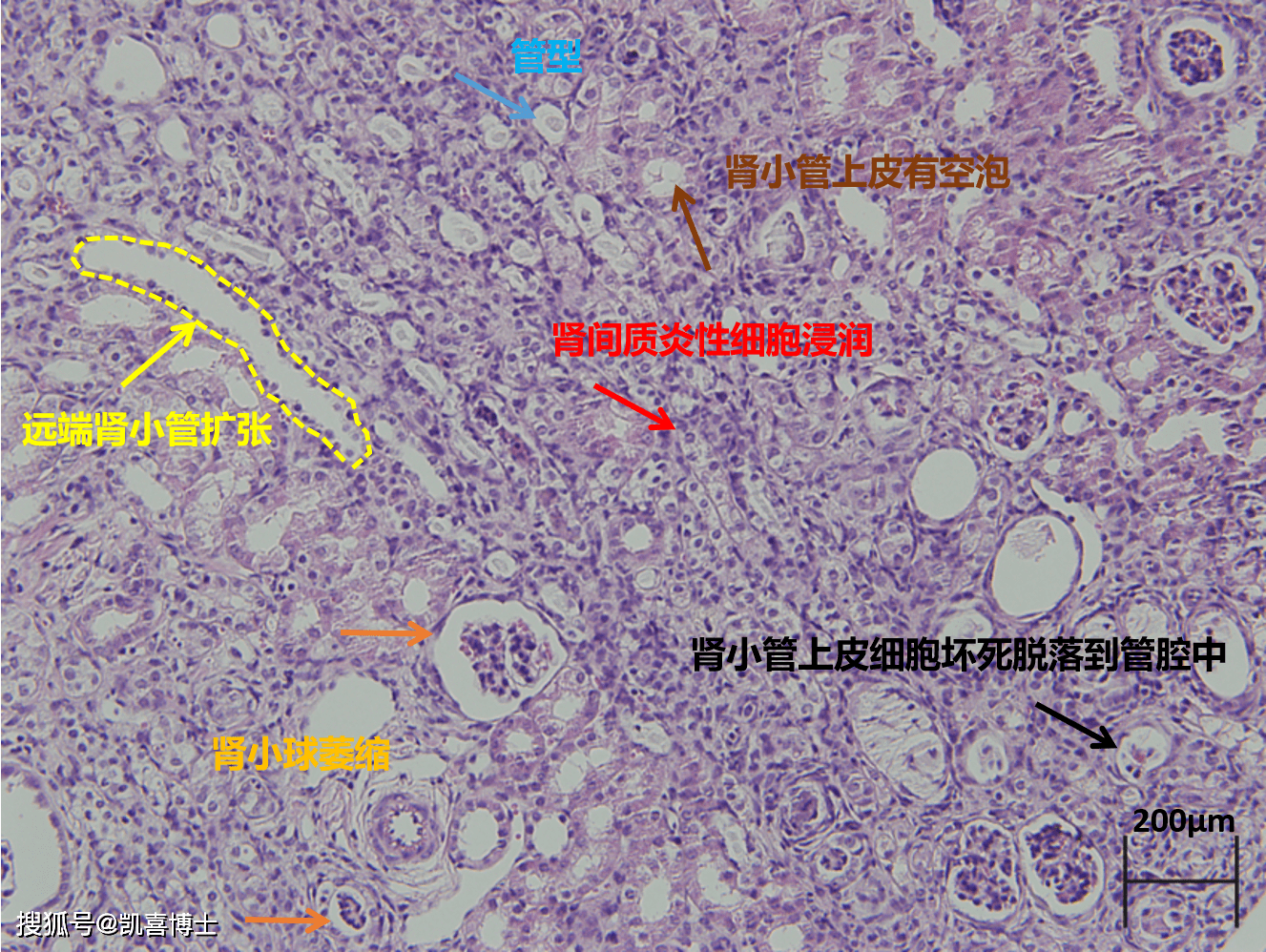 部分肾脏在切片中显示:肾间质炎性细胞浸润,肾小球萎缩,远端肾小管