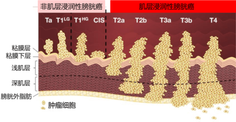 根據組織來源,膀胱癌可分為尿路上皮癌,膀胱鱗癌,膀胱腺癌,膀胱肉瘤等