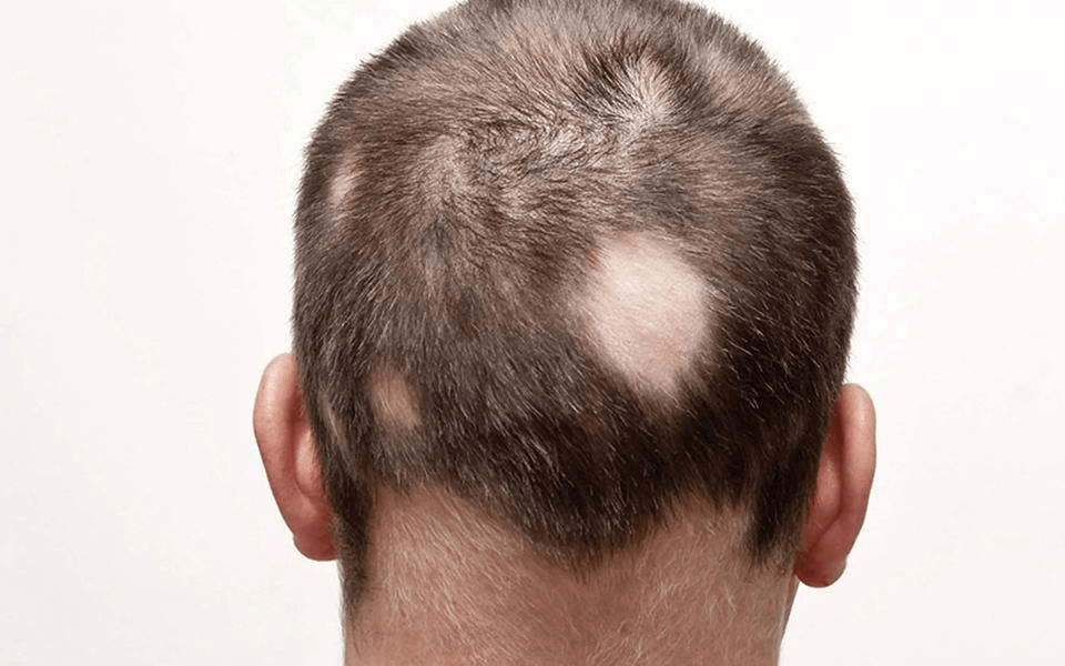 休止期脱发(病理性)由多种应激因素引起的正常的休止期杵状发过多的