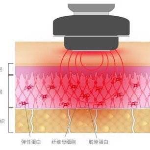 脸部眼纹、眼袋、黑眼圈有救了！美容院开发的新项目？