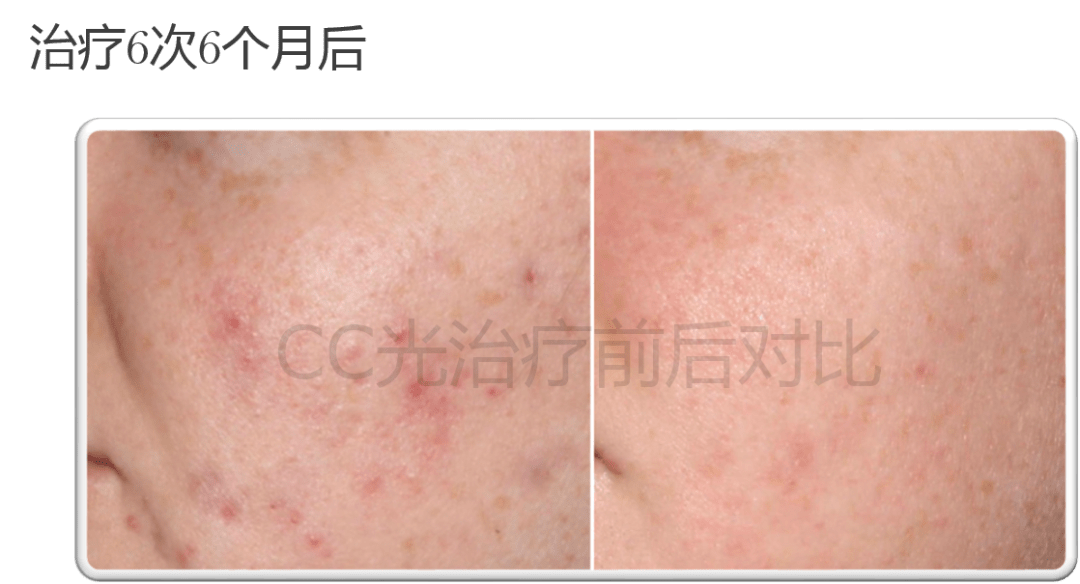 人群什么是光子嫩肤？