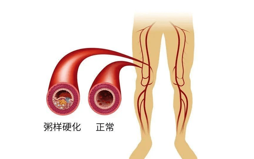 并发症|中日友好医院李爱国主任医师为您解说预防糖尿病并发症要做哪些检查?