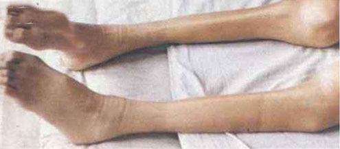 症状|肌肉萎缩的症状表现有哪些?