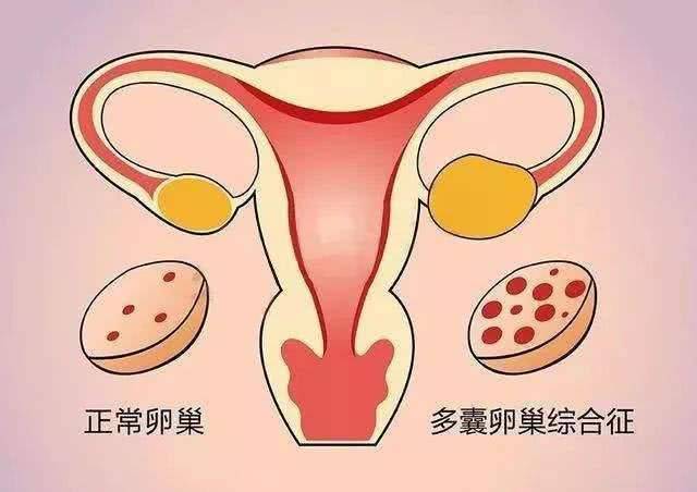 得了卵巢多囊怎么办