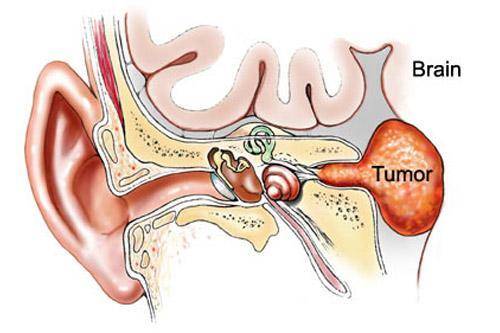 对于小的听神经瘤,做到面神经解剖保留而功能尽管术后早期轻度障碍,数
