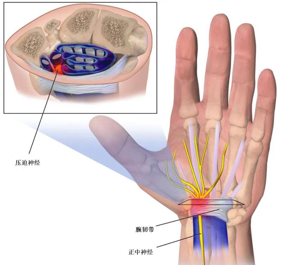 正中神经损伤是怎么一回事?