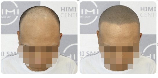 危机黑米3D纹发： 远离秃头危机，这5大类“养发食物”吃起来！