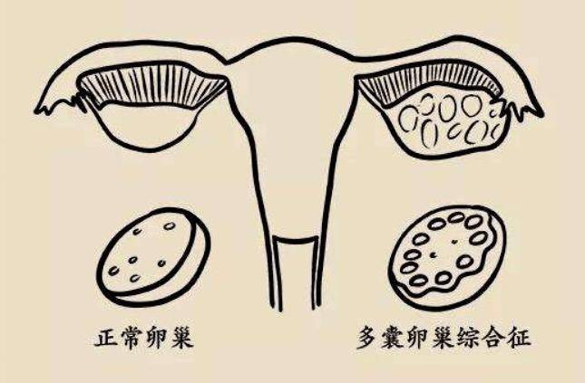 内分泌|患了多囊，女性朋友该怎么办？下面这三种错误认识，一定不要有