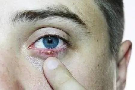 眼睛梅毒症状图片