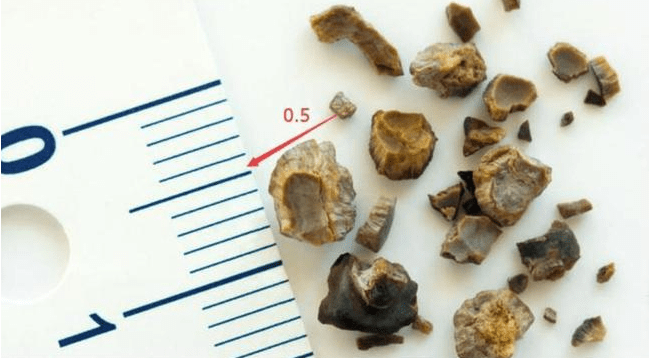 治疗|肾结石会有哪些症状?