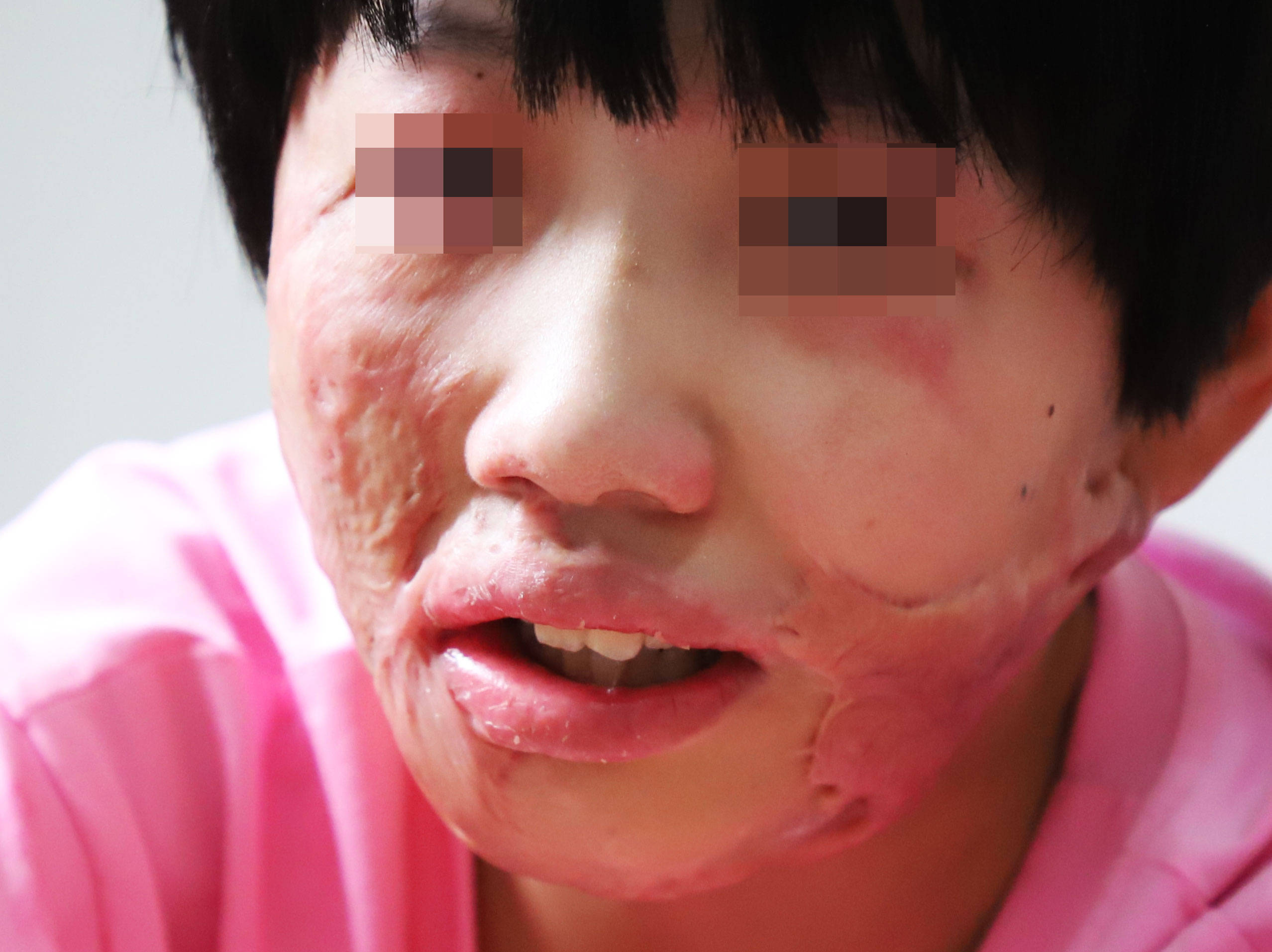 郑州市第二中医院:烧烫伤疤痕如何治疗好?