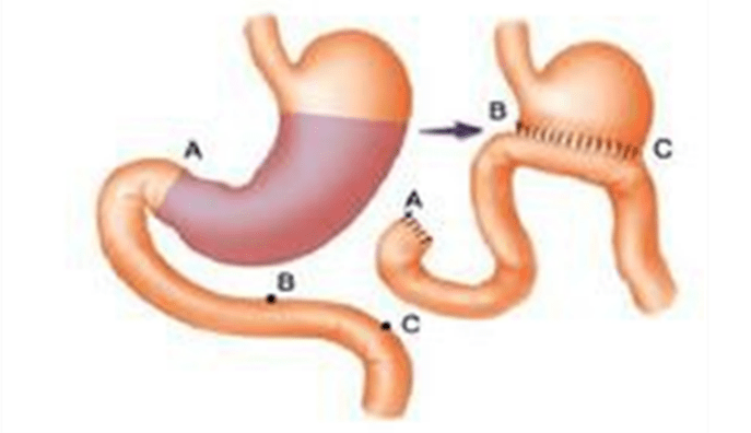 十二指肠残端破裂答案:e解析:十二指肠残端破裂是毕Ⅱ式胃大部切除术