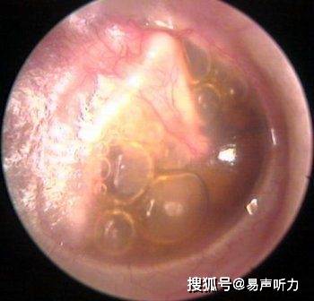 中耳炎引起鼓室积液05、其他中耳疾病其他中耳疾病也会导致暂时性听力下