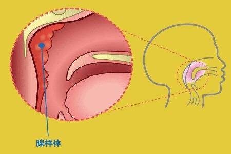 腺樣體肥大會造成鼻塞,讓孩子轉成口呼吸.