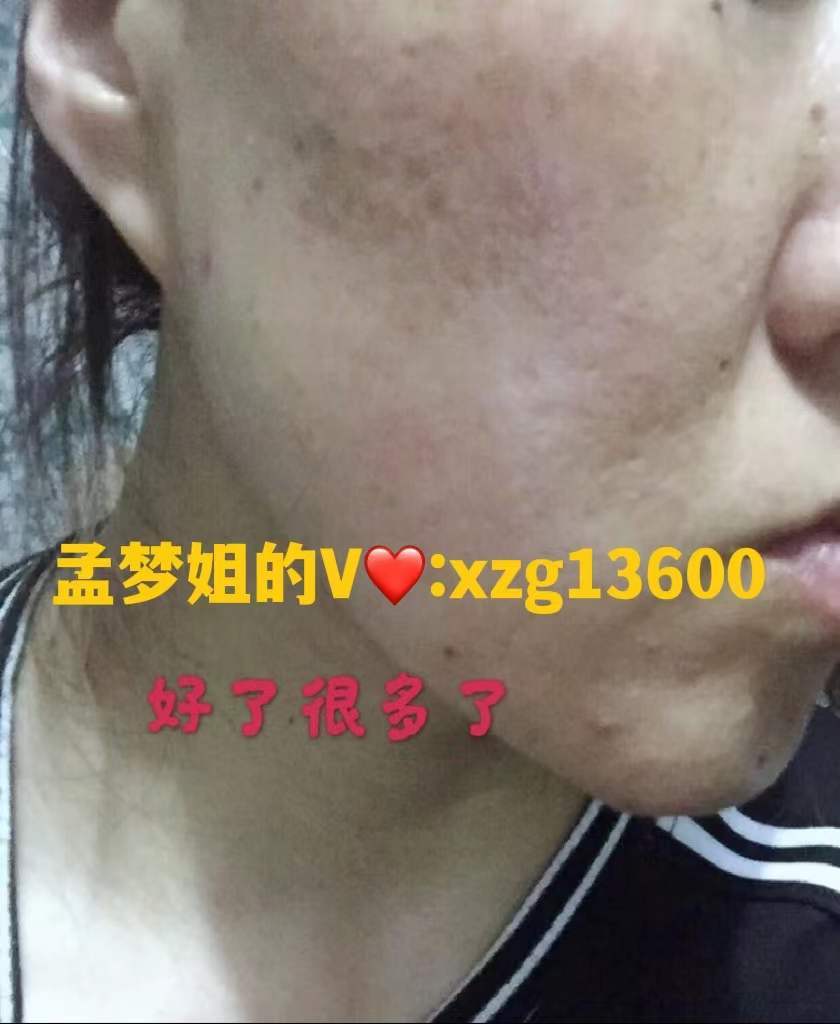 方法李凤心录--李凤的战痘心酸历程