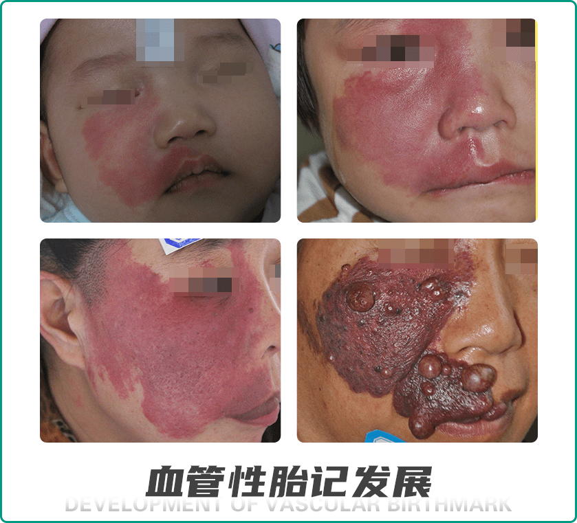 郑州市第二中医院警惕鲜红斑痣危害等级