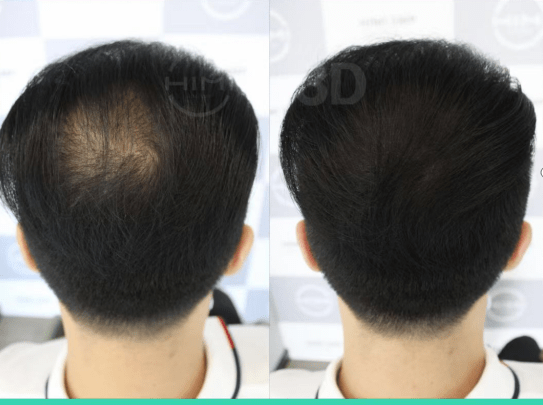 因为黑米3D纹发：头发护理小知识，盐水洗头发！