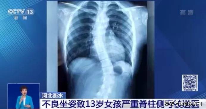 上海市教委|中小学生脊柱侧弯人数已超500万！那该怎么办？