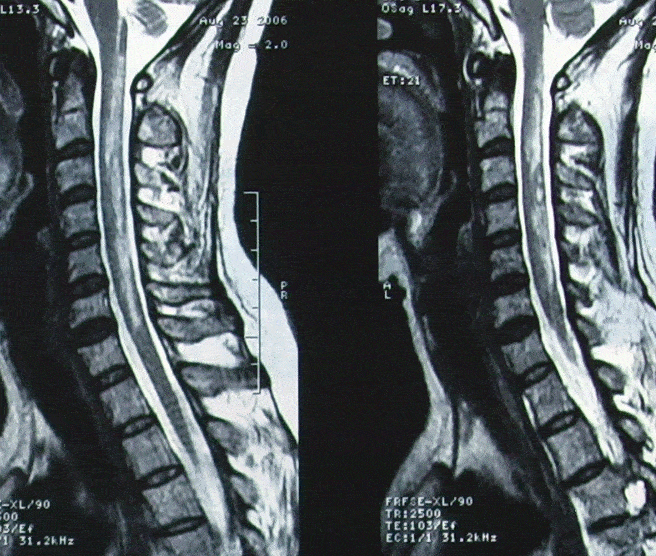 脊髓损伤磁共振图片