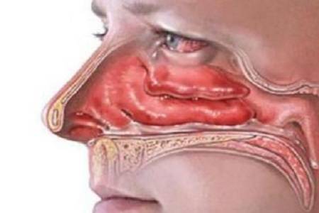 鼻结石也分真,假如鼻腔里的异物是外面带进去的,就称之为假性鼻结石