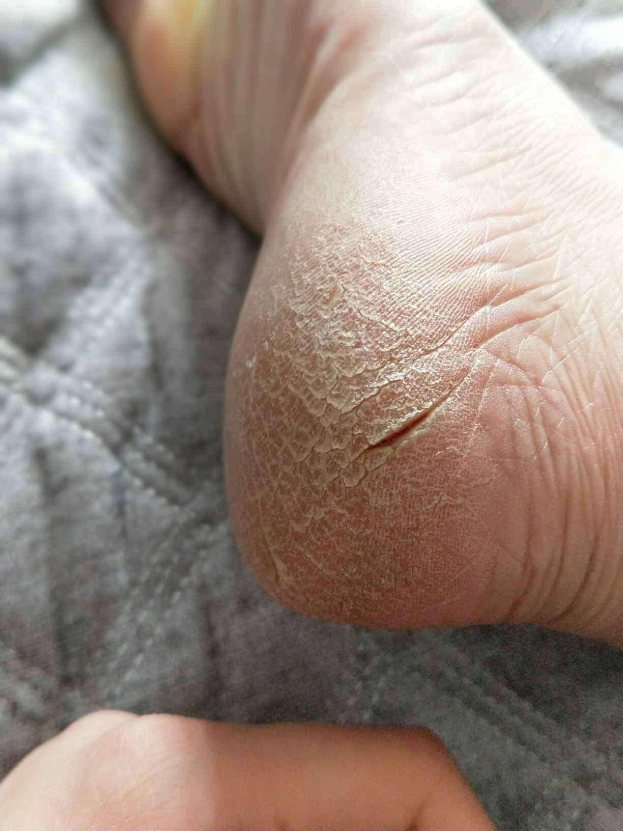 脚后跟起硬皮,摸起来很粗糙,怎么回事啊?_皮肤_裂口_宁止