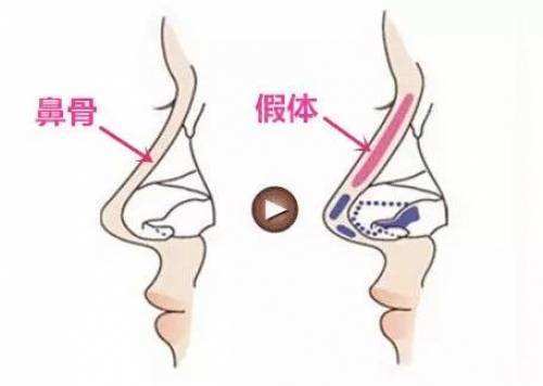 foho我做假体隆鼻出现后遗症了，真的后悔了