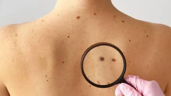 一文为你解读清楚_皮肤_肿瘤_治疗