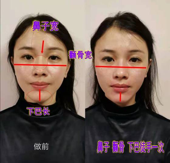 下巴法令纹整形 颧骨内推鼻子整形 下巴整形效果哪家好专业排名？专家用什么材料？