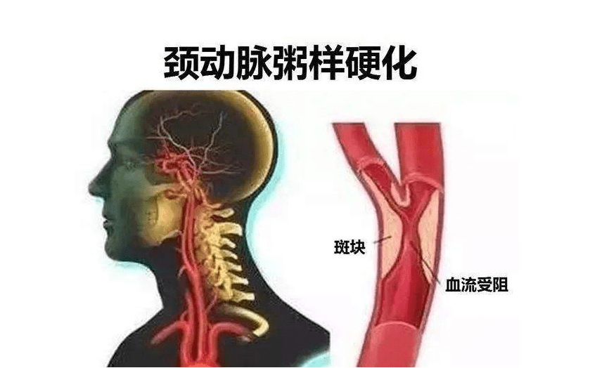 张学文:治颈动脉硬化斑块经验