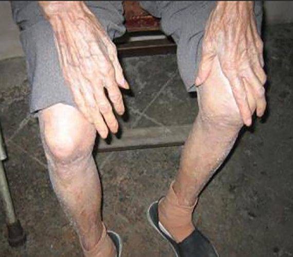 尺神经损伤如何治疗?