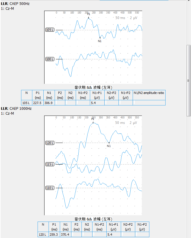 左耳a型 右耳as型声导抗最小掩蔽级测试:设备最大掩蔽声输出无法掩蔽