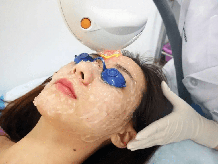 治疗皮肤李佳佳：毛孔粗大怎么办？