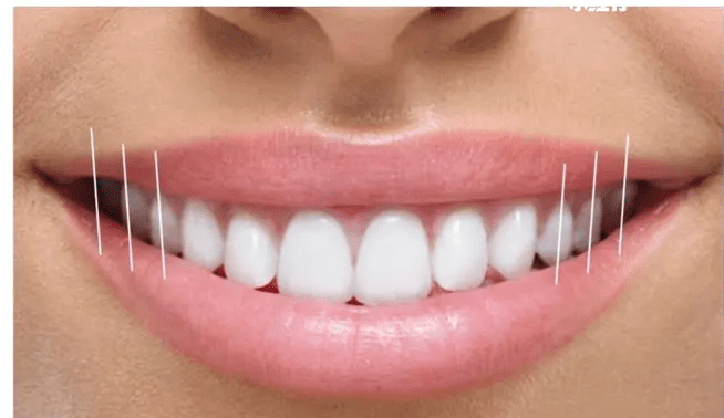 格伦菲尔吴敏慧医生:正畸是如何改善微笑线的?_牙龈_牙齿_弧度