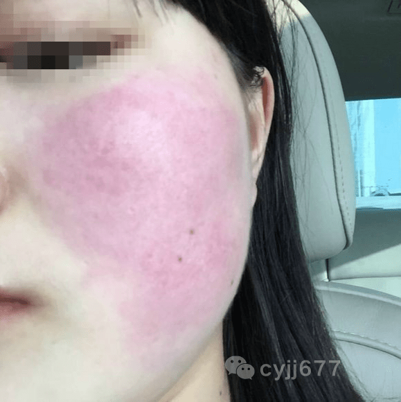 激素依赖性皮炎是由于糖皮质激素引起的,这种激素多用在功能强大的