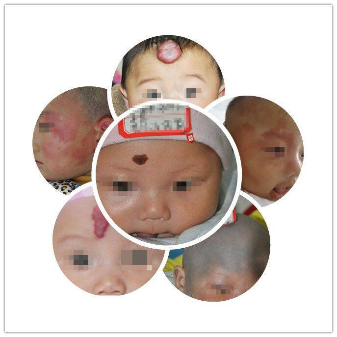 河南胎记医院郑州市第二中医院新生儿胎记出现的主要原因