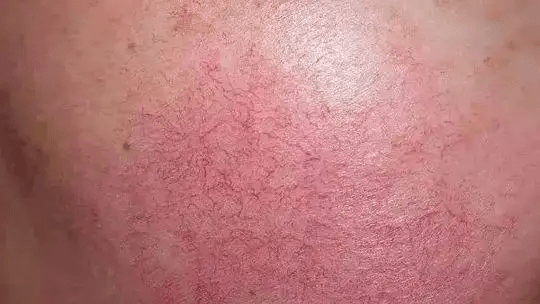敏感肌肤的特征是什么?适合敏感肌脸颊发红如何修复