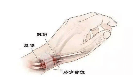 腕关节腱鞘炎解剖图图片